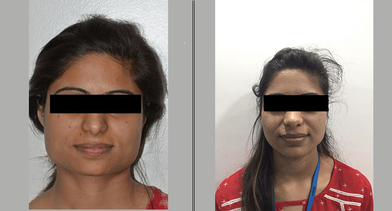 Square Face Deformity in Pune